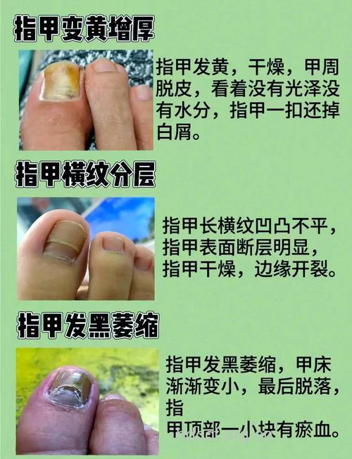 早老综合症能引起灰指甲