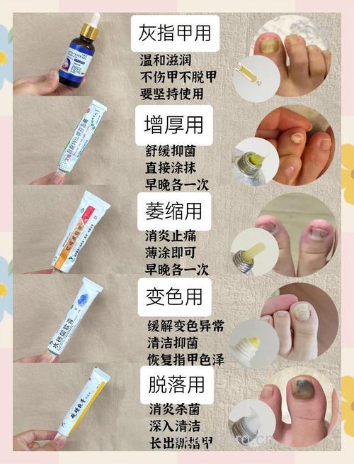 误听偏方治灰指甲治出皮炎