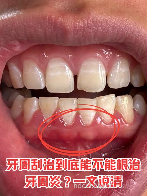 牙周炎严重时会导致牙齿脱落