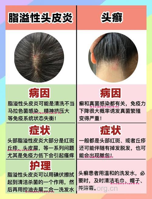头癣需要与哪些疾病相鉴别