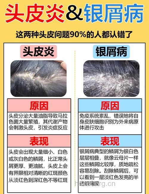 头癣临床各种的治疗方法