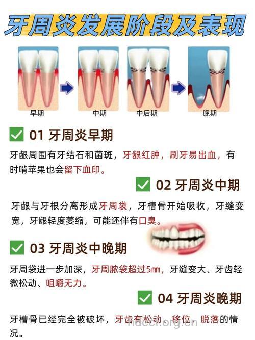 孕妇为什么会导致牙周炎