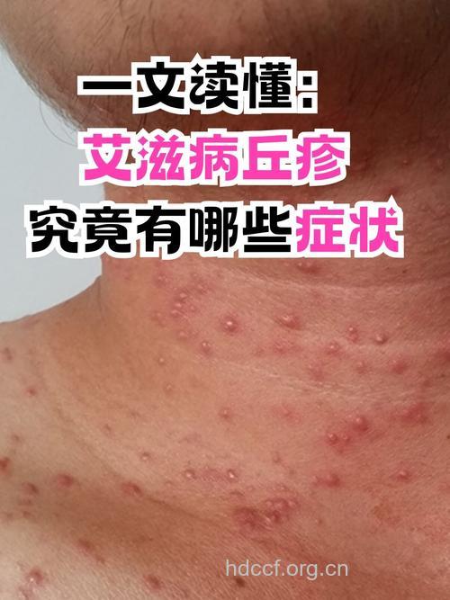 艾滋病的常见症状