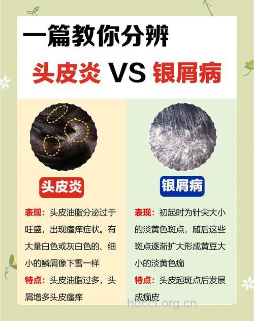 头癣的鉴别方法