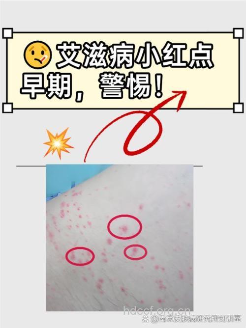 艾滋病感染的早期识别标志