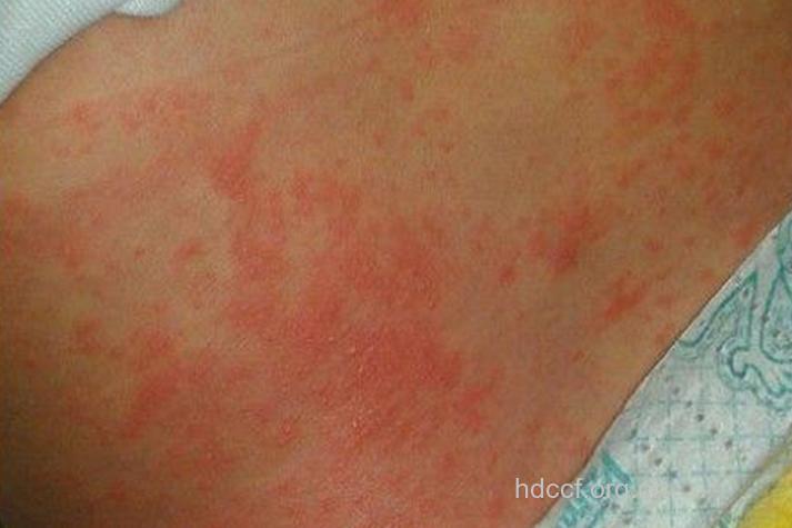 儿童的中度艾滋病症状