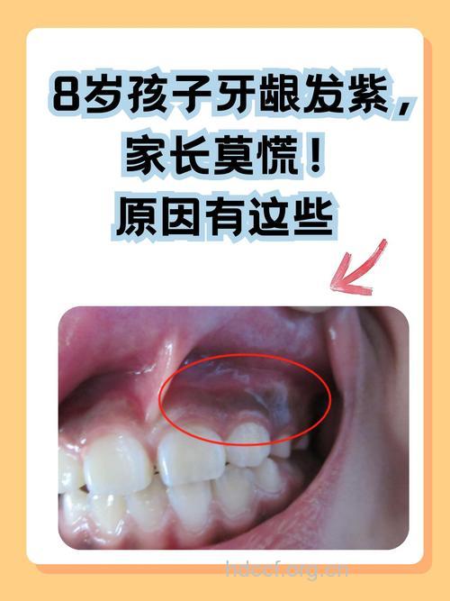 儿童不会患牙周病吗