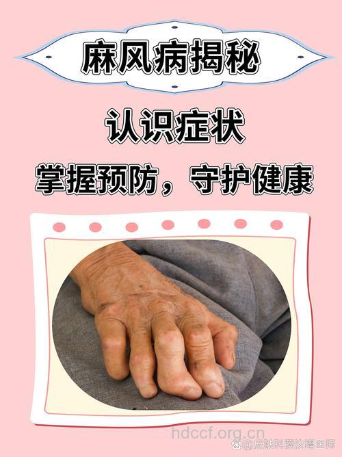 麻风病有哪几类？