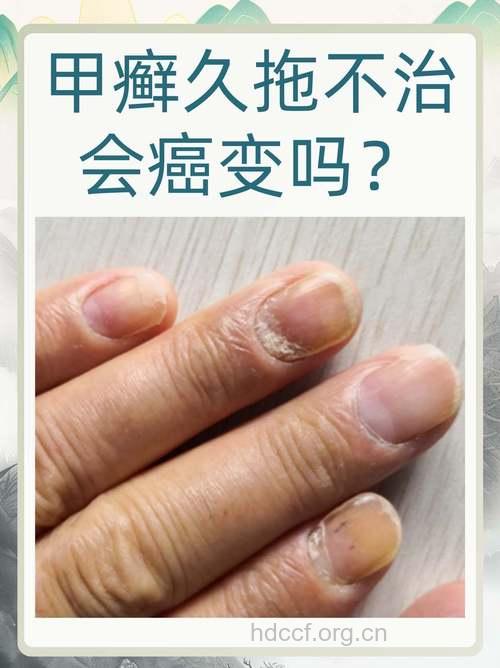 营养性疾病会引起指甲病变