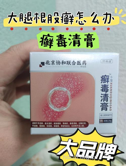 阴癣的治疗偏方