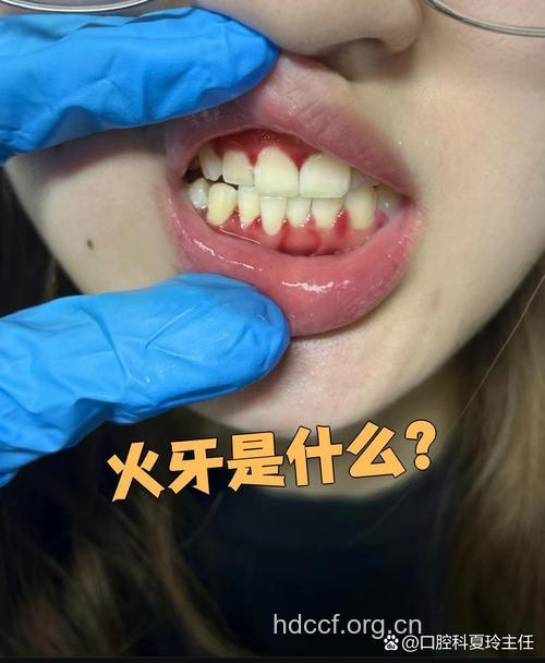 俗称“火牙”是指牙齿着火？