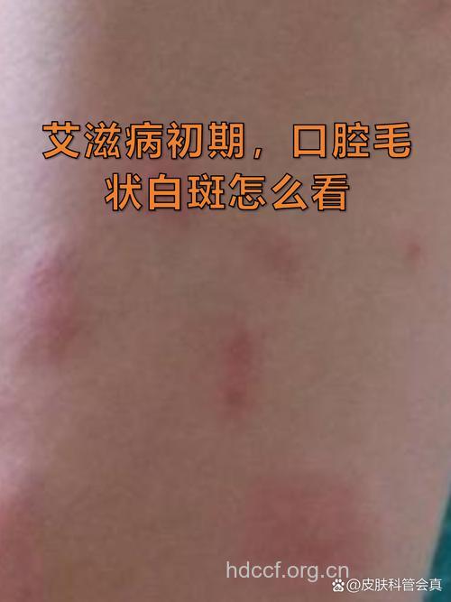 艾滋初期症状要清楚 唾液检测准确度高