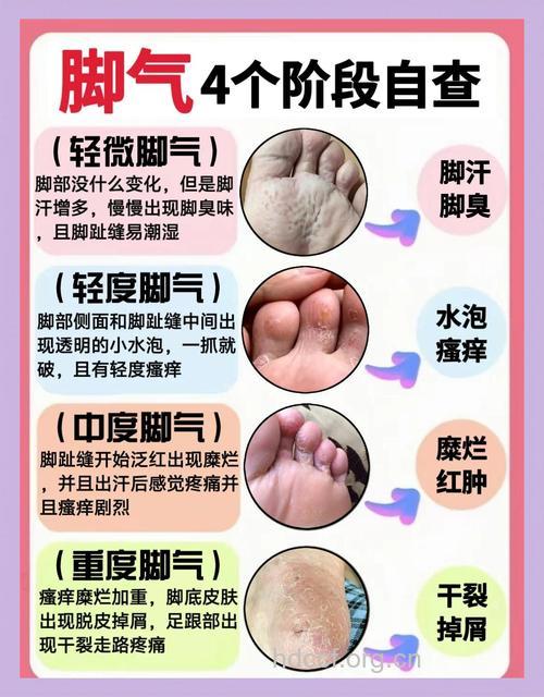 告别脚气从生活习惯开始