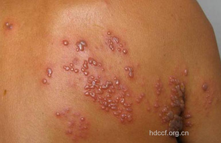 男性艾滋病患者早期有什么症状