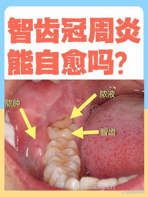 智齿冠周炎是什么？