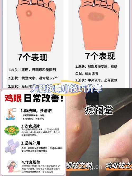 鸡眼应该如何治疗?