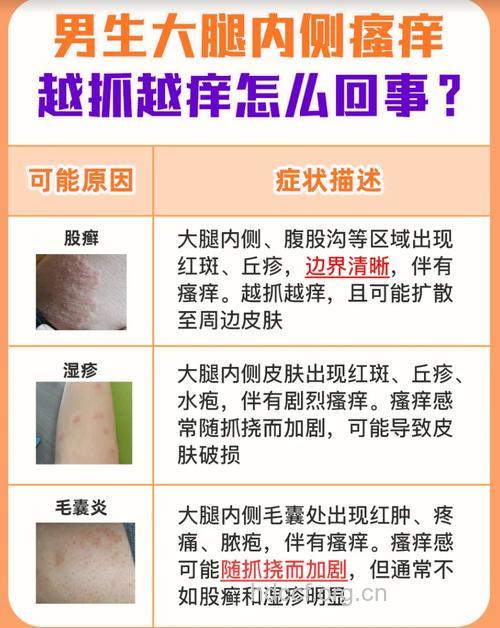 股癣患者注意啦