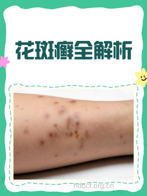 花斑癣局部诊治总集