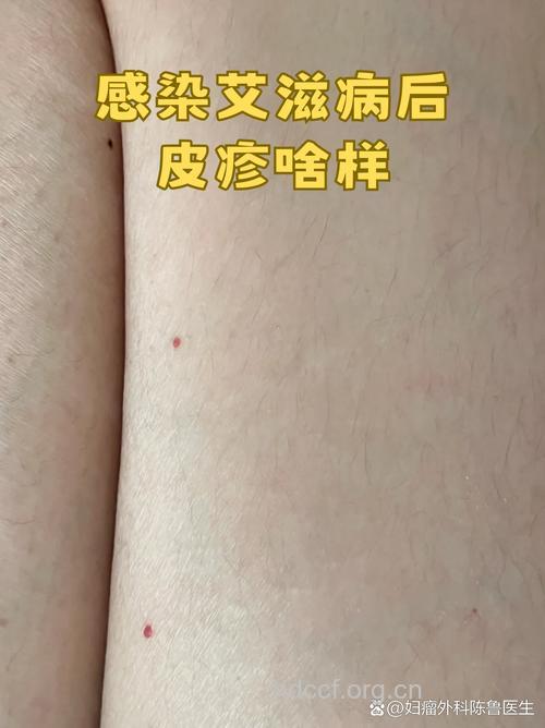 感染艾滋病最常见的症状有哪些