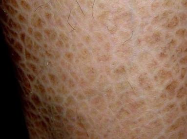 患上鱼鳞病会遗传吗?