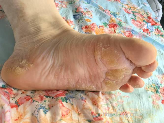 糖尿病患者 常见的皮肤病