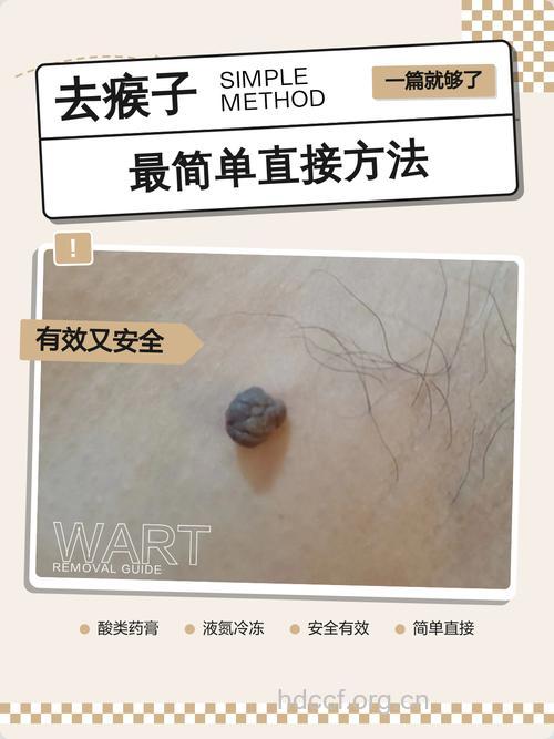 中医八招 除去顽固“瘊子”