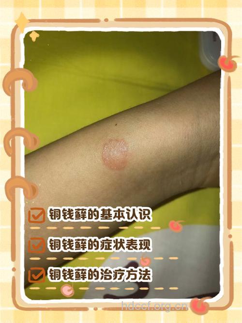 “钱癣”的病因和表现