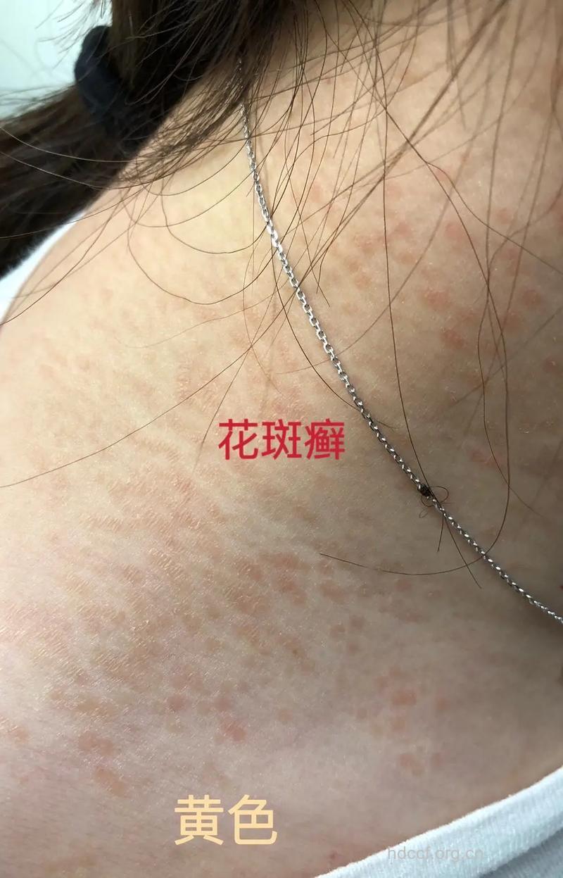 真菌性皮肤病有哪些?