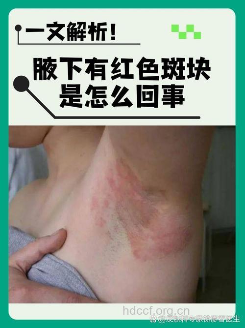 腋毛变色了是怎么回事？