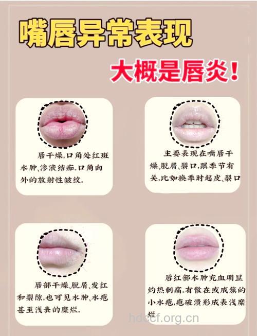怎么预防口角炎方法