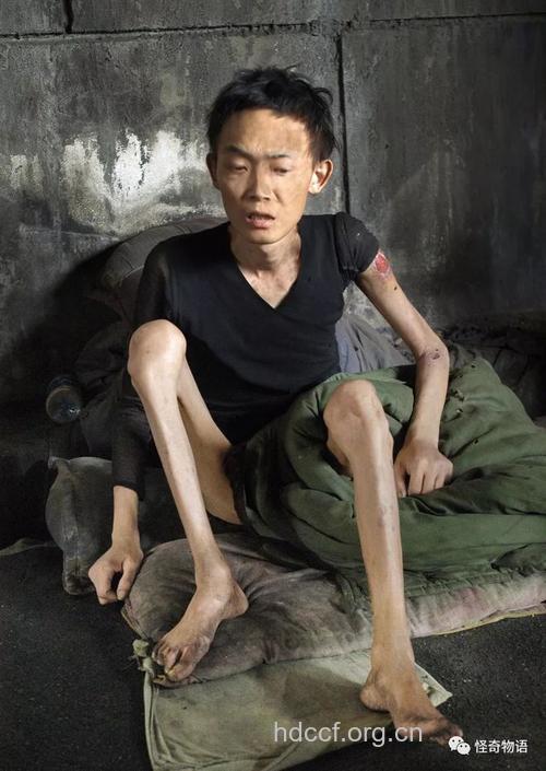 80%以上的艾滋病患者极度消瘦