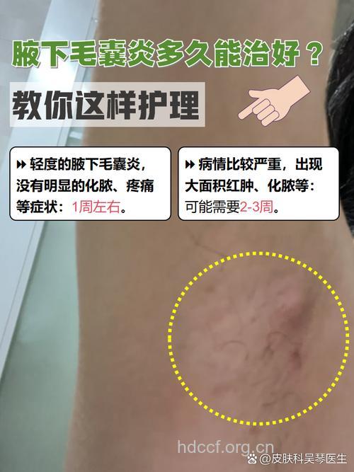 如何治疗腋下毛囊炎？