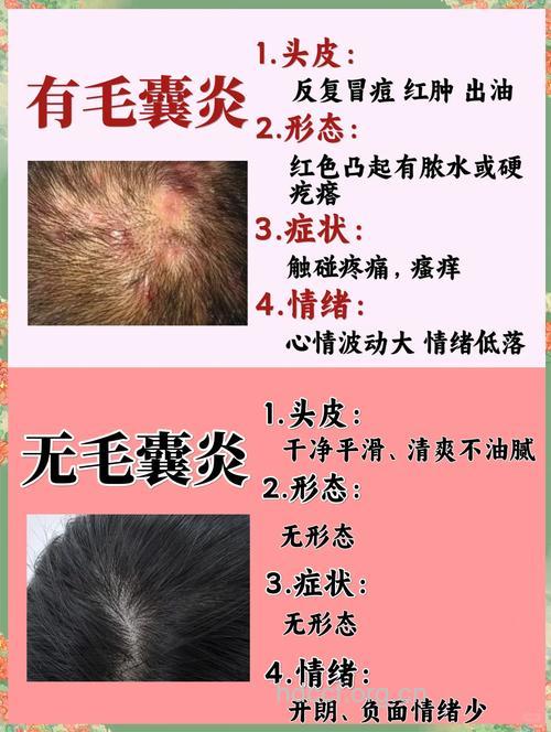 白头不可乱拔 否则将得毛囊炎