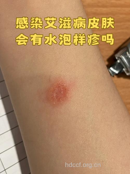 水痘和疱疹是艾滋病早期症状吗