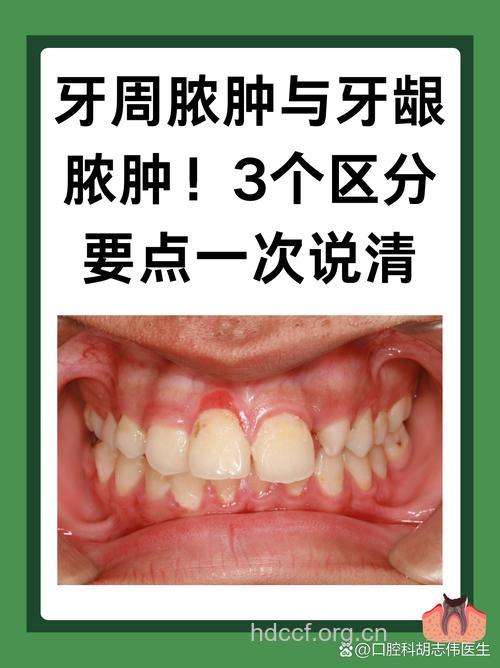 牙周脓肿是牙周炎吗