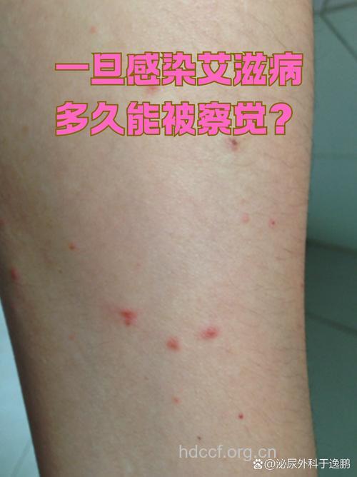 艾滋病潜伏期症状类型与时间长短