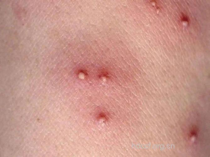艾滋病初期皮疹皮肤症状