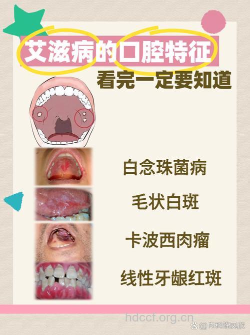 艾滋病初期口腔症状及治疗保健