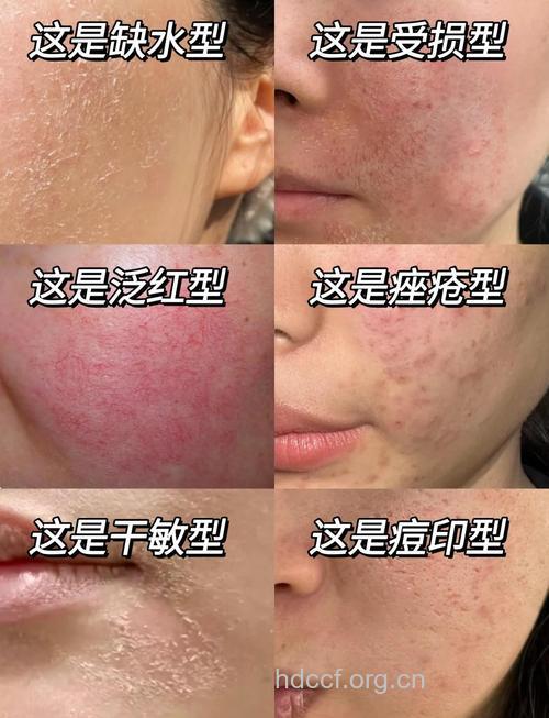 哪些人容易得化妆品皮炎