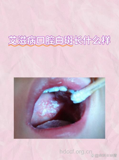 口腔舌头白斑不一定是艾滋病初期症状