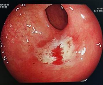 胃溃疡出血有哪些症状表现