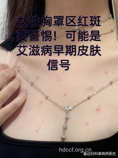 艾滋病初期肺部感染的种类与症状