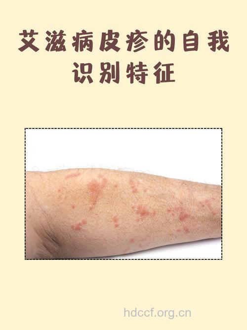 艾滋病初期症状解答