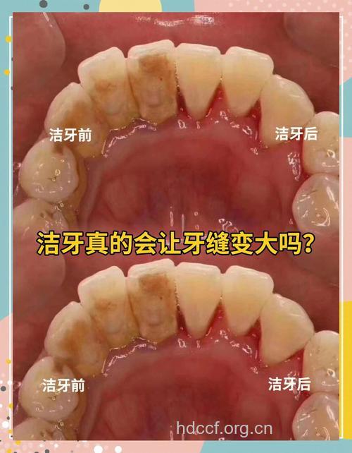 洗牙后牙缝变大不用怕