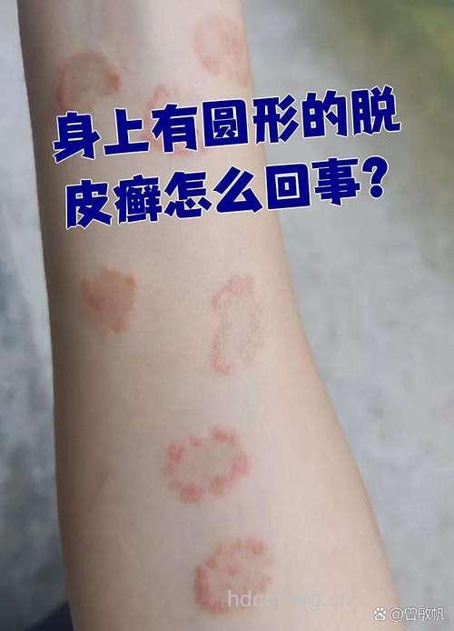 真菌性皮肤病的真菌有哪些？