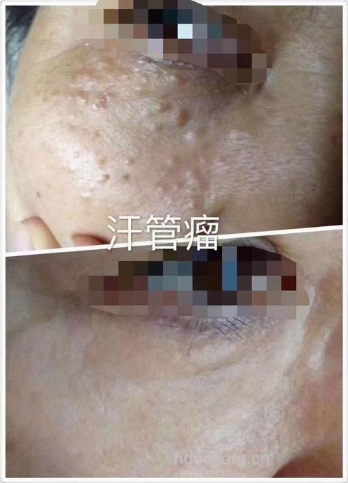 汗管瘤患者饮酒有什么危害