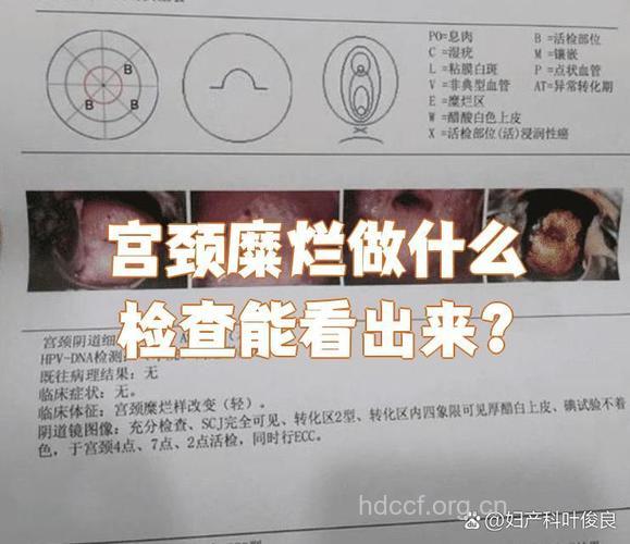 宫颈糜烂要做哪些检查