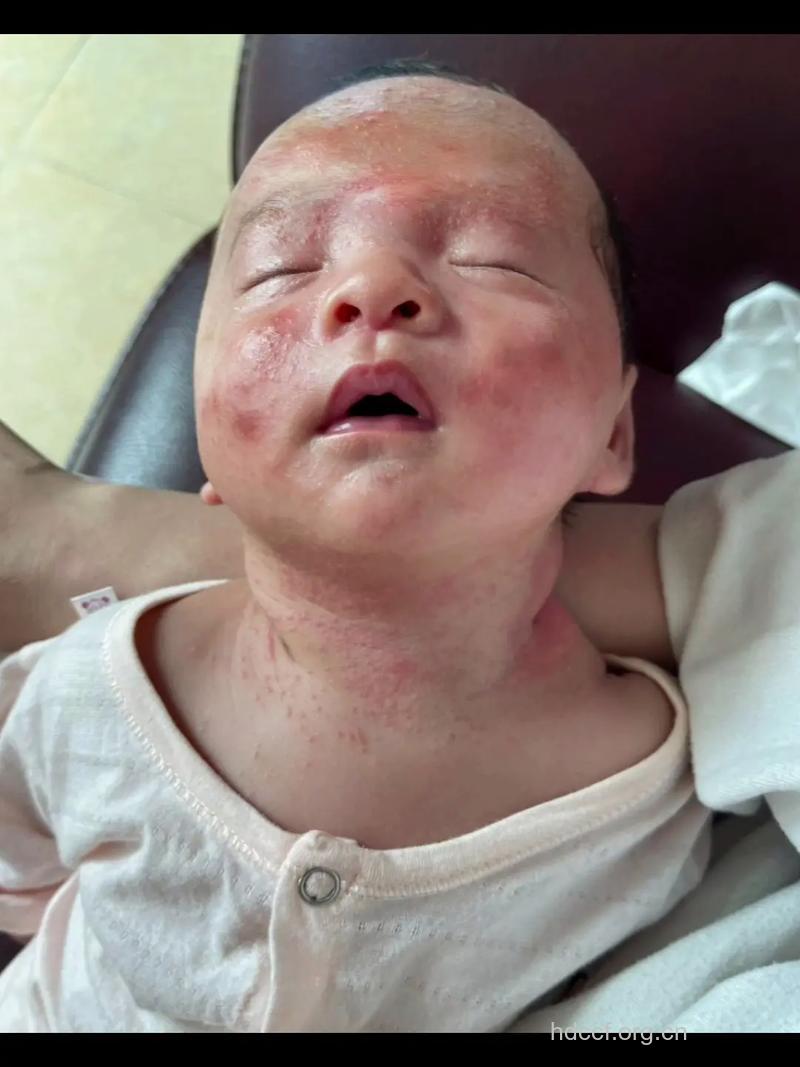 婴儿感染艾滋病的早期症状有哪些