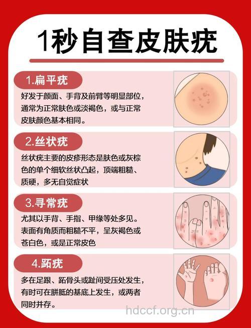 寻常疣治疗的注意事项　