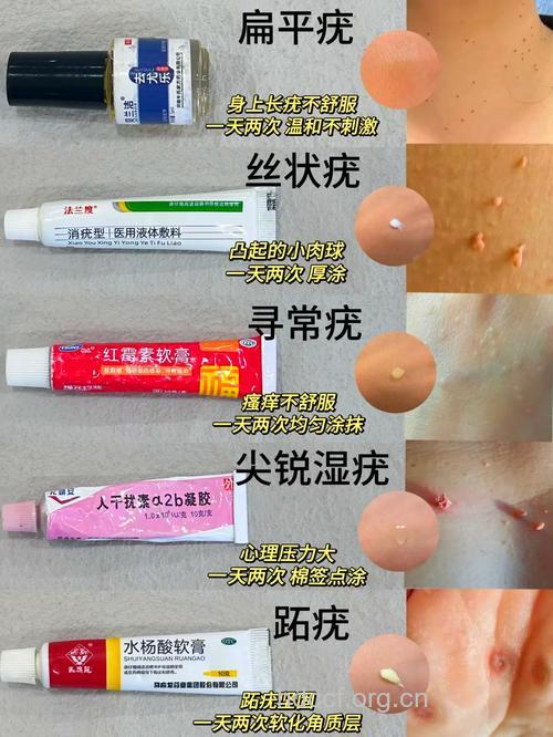 瘊子有哪些治疗方法?